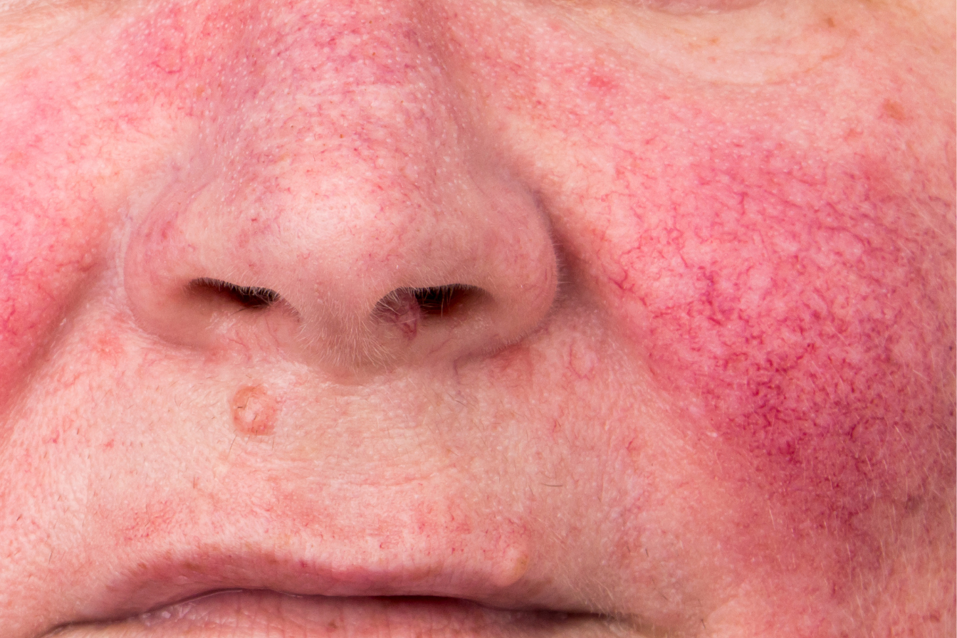 Laser for redness & vascular concerns National Skin Cancer Centres